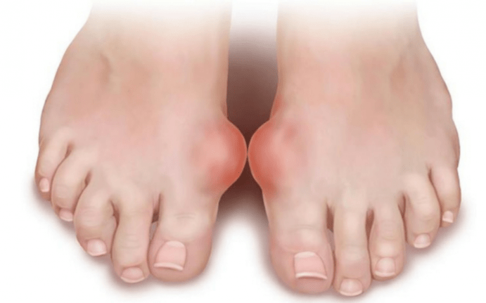 deformace nohy jako příčina výskytu plísní na nohou