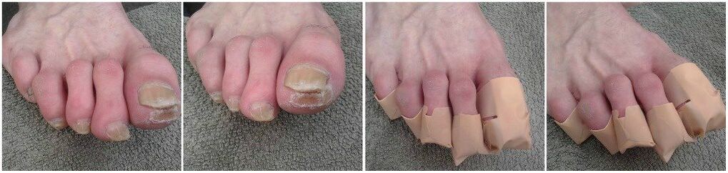 Nanášení náplastí na nehty na nohou