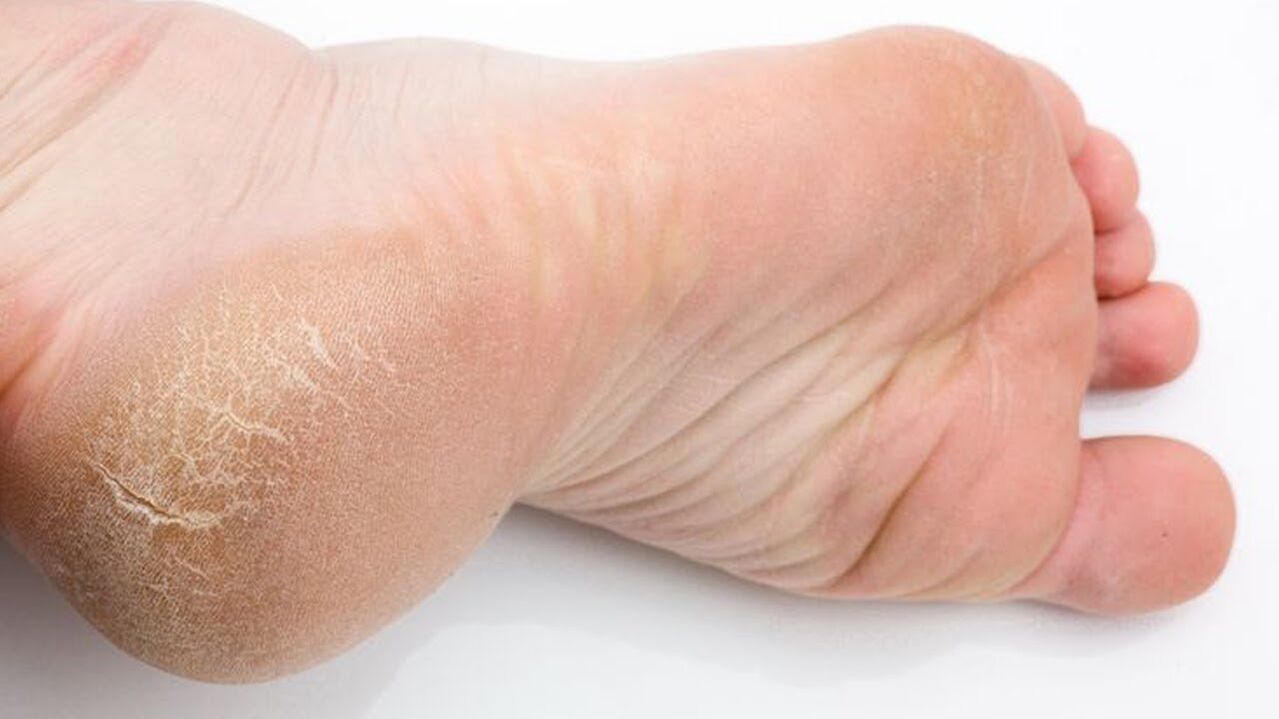 houba na kůži nohou