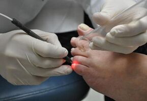 Laserová léčba plísní nehtů na nohou