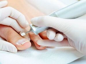 Terapeutická pedikúra proti plísním nehtů na nohou