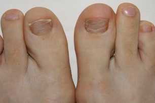 Příznaky výskytu plísní na nohou